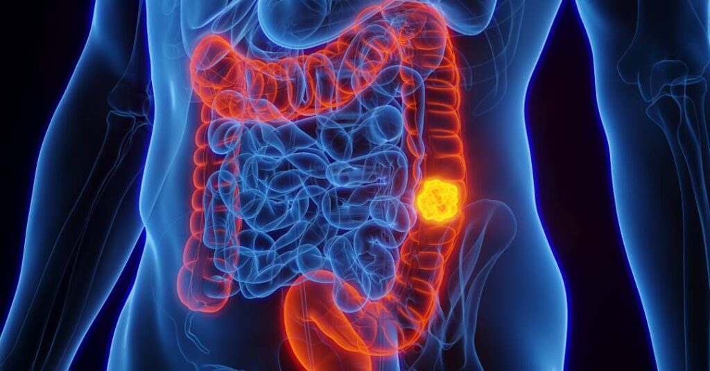 por-que-o-cancer-de-intestino-em-jovens-tornou-se-preocupacao-global