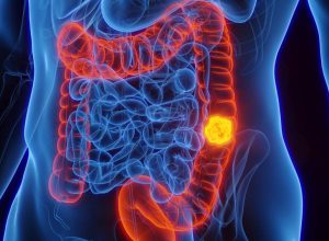 por-que-o-cancer-de-intestino-em-jovens-tornou-se-preocupacao-global